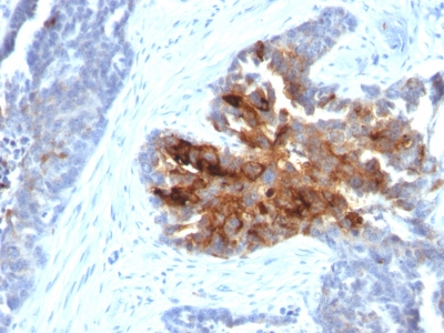 FFPE human ovarian carcinoma sections stained with 100 ul anti-TAG-72 / CA72.4 (clone B72.3 + CA72/733) at 1:100. HIER epitope retrieval prior to staining was performed in 10mM Citrate, pH 6.0.